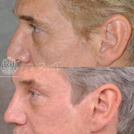 Beverly Hills Center Male Patient Before and After Auralyft, Mini Brow Lift, Upper Bleph, Revision Rhinoplasty, Modified Upper Lip Lift