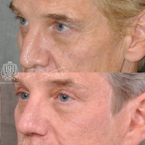 Beverly Hills Center Male Patient Before and After Auralyft, Mini Brow Lift, Upper Bleph, Revision Rhinoplasty, Modified Upper Lip Lift