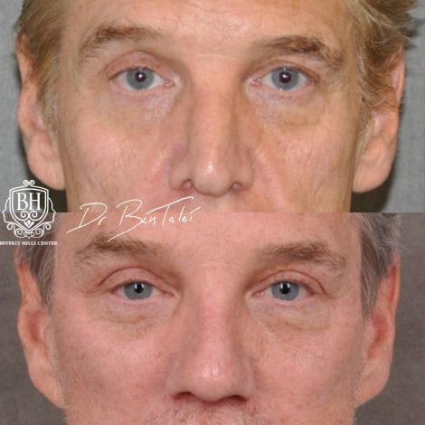 Beverly Hills Center Male Patient Before and After Auralyft, Mini Brow Lift, Upper Bleph, Revision Rhinoplasty, Modified Upper Lip Lift
