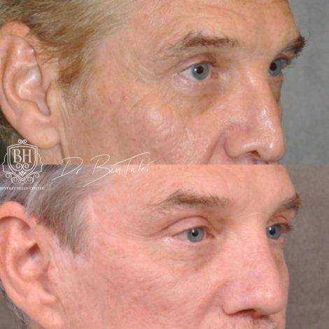 Beverly Hills Center Male Patient Before and After Auralyft, Mini Brow Lift, Upper Bleph, Revision Rhinoplasty, Modified Upper Lip Lift