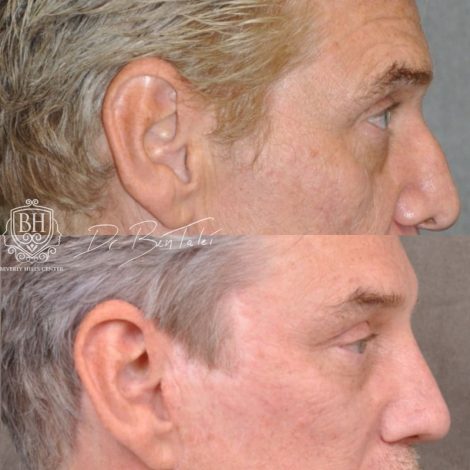 Beverly Hills Center Male Patient Before and After Auralyft, Mini Brow Lift, Upper Bleph, Revision Rhinoplasty, Modified Upper Lip Lift