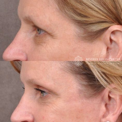 Beverly Hills Center Female Patient Before and After Facial Rejuvenation Procedure