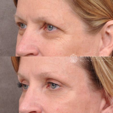 Beverly Hills Center Female Patient Before and After Facial Rejuvenation Procedure