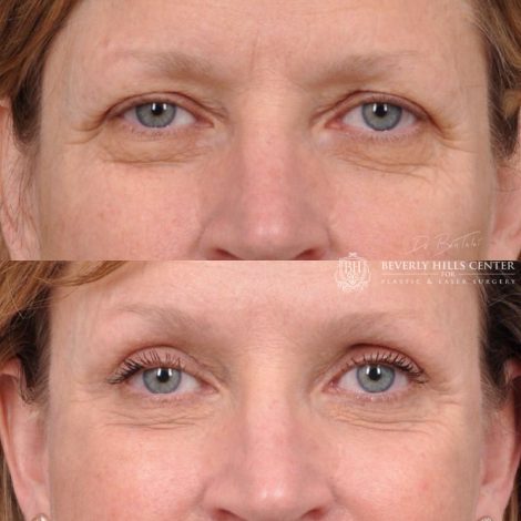 Beverly Hills Center Female Patient Before and After Facial Rejuvenation Procedure