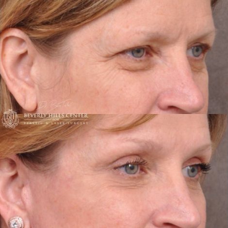 Beverly Hills Center Female Patient Before and After Facial Rejuvenation Procedure