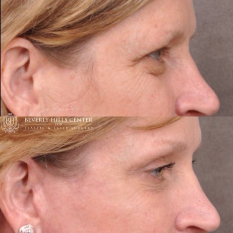 Beverly Hills Center Female Patient Before and After Facial Rejuvenation Procedure