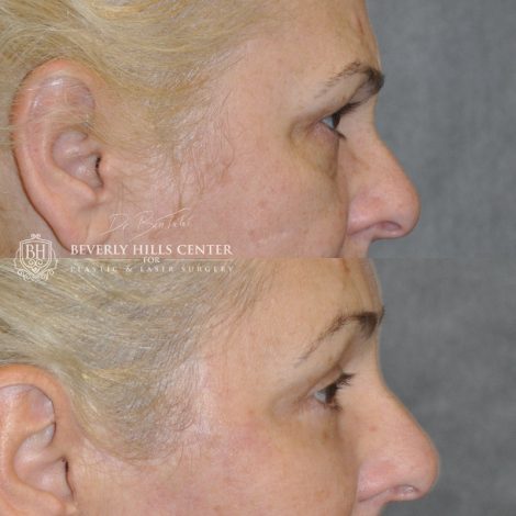 Beverly Hills Center Female Patient Before and After Facial Rejuvenation Procedures