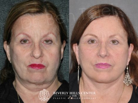 Beverly Hills Center Female Patient Before and After Auralyft Procedure