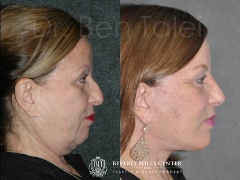 Beverly Hills Center Female Patient Before and After Auralyft Procedure