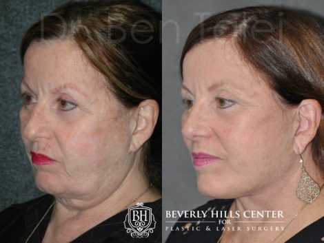 Beverly Hills Center Female Patient Before and After Auralyft Procedure