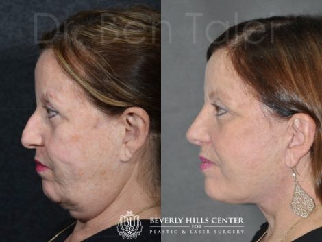 Beverly Hills Center Female Patient Before and After Auralyft Procedure