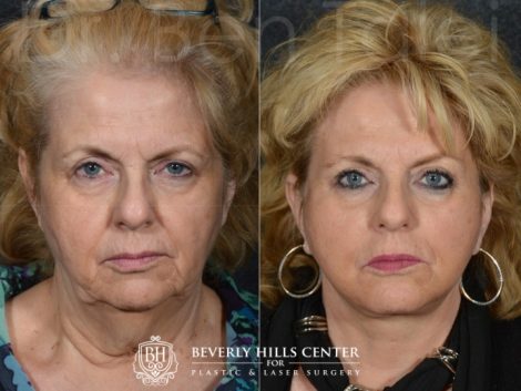 Beverly Hills Center Female Patient Before and After Face and Neck lifting using the SMART Deep Plane Technique and Neck Liposuction