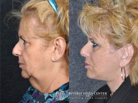 Beverly Hills Center Female Patient Before and After Face and Neck lifting using the SMART Deep Plane Technique and Neck Liposuction