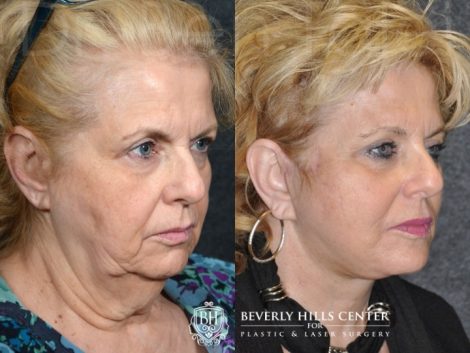 Beverly Hills Center Female Patient Before and After Face and Neck lifting using the SMART Deep Plane Technique and Neck Liposuction