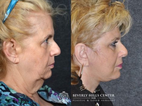 Beverly Hills Center Female Patient Before and After Face and Neck lifting using the SMART Deep Plane Technique and Neck Liposuction