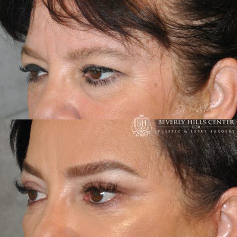 Beverly Hills Center Female Patient Before and After Brow and Eyelid Rejuvenation Procedure