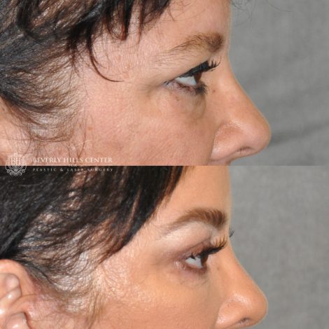 Beverly Hills Center Female Patient Before and After Brow and Eyelid Rejuvenation Procedure