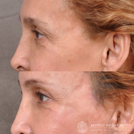 Beverly Hills Center Female Patient Before and After Facial Rejuvenation Procedures
