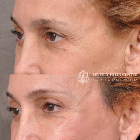 Beverly Hills Center Female Patient Before and After Facial Rejuvenation Procedures