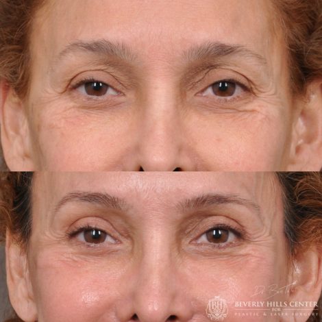 Beverly Hills Center Female Patient Before and After Facial Rejuvenation Procedures