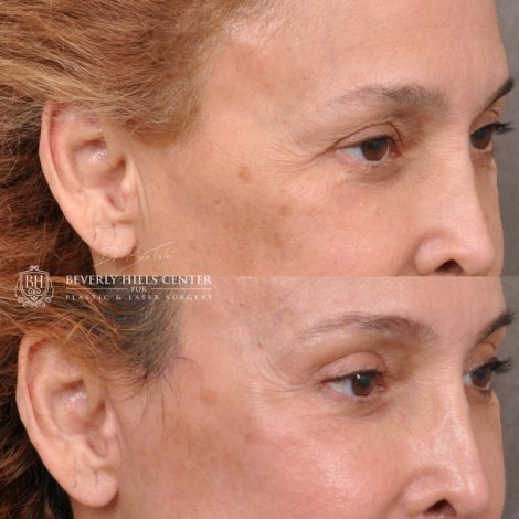 Beverly Hills Center Female Patient Before and After Facial Rejuvenation Procedures