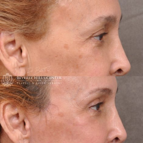 Beverly Hills Center Female Patient Before and After Facial Rejuvenation Procedures