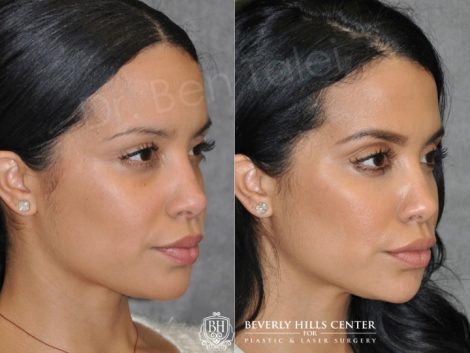 Beverly Hills Center Female Patient Before and After Non-surgical Lip, Cheek and Eye Enhancement