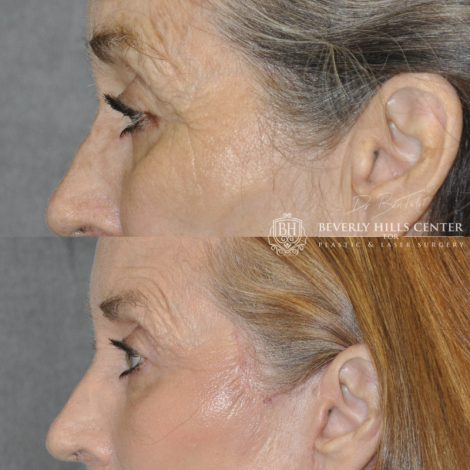 Beverly Hills Center Female Patient Before and After AuraLyft Procedure with Upper Eyelid Ptosis repair