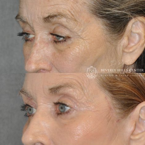 Beverly Hills Center Female Patient Before and After AuraLyft Procedure with Upper Eyelid Ptosis repair