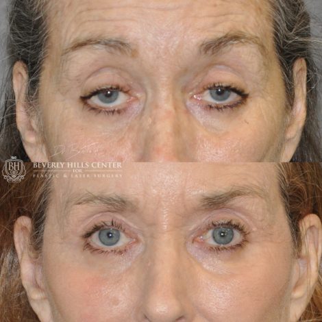 Beverly Hills Center Female Patient Before and After AuraLyft Procedure with Upper Eyelid Ptosis repair
