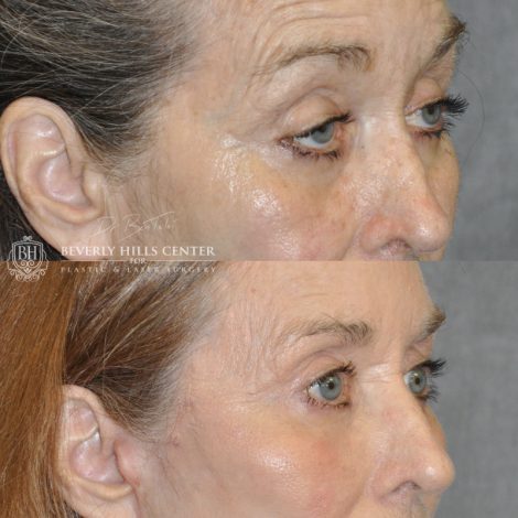 Beverly Hills Center Female Patient Before and After AuraLyft Procedure with Upper Eyelid Ptosis repair