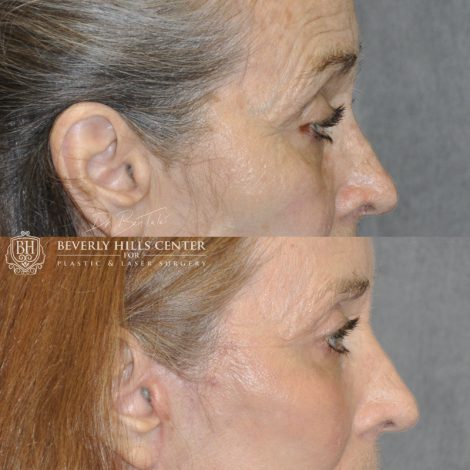 Beverly Hills Center Female Patient Before and After AuraLyft Procedure with Upper Eyelid Ptosis repair