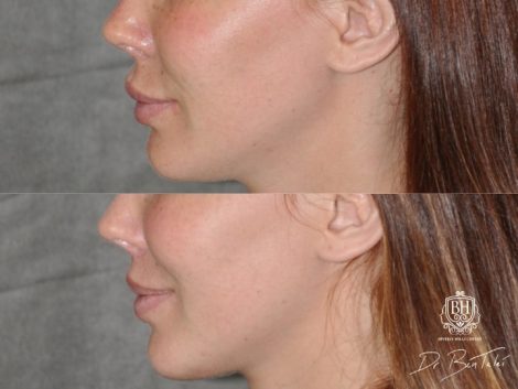Beverly Hills Center Female Patient Before and After Modified Upper Lip Lift