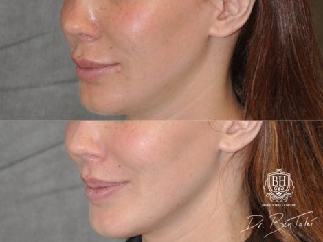 Beverly Hills Center Female Patient Before and After Modified Upper Lip Lift