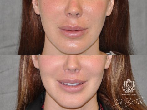 Beverly Hills Center Female Patient Before and After Modified Upper Lip Lift