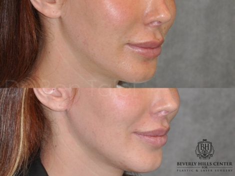 Beverly Hills Center Female Patient Before and After Modified Upper Lip Lift