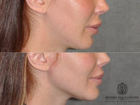 Beverly Hills Center Female Patient Before and After Modified Upper Lip Lift
