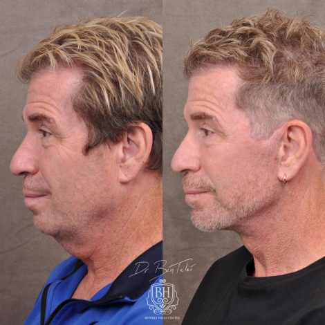 Beverly Hills Center Male Patient Before and After AuraLyft