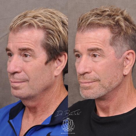 Beverly Hills Center Male Patient Before and After AuraLyft