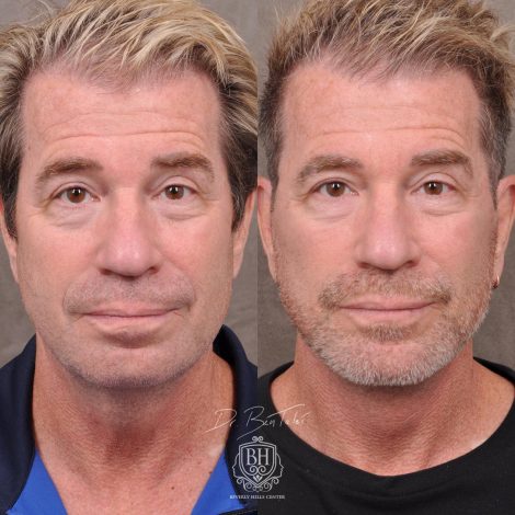Beverly Hills Center Male Patient Before and After AuraLyft