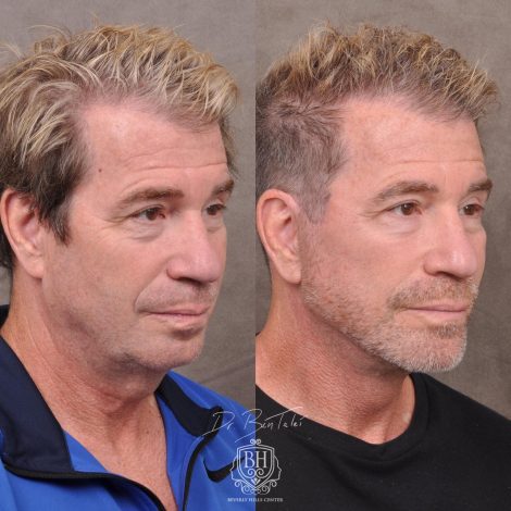 Beverly Hills Center Male Patient Before and After AuraLyft