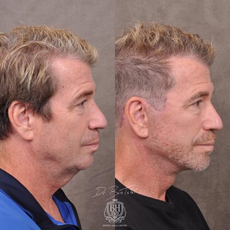 Beverly Hills Center Male Patient Before and After AuraLyft