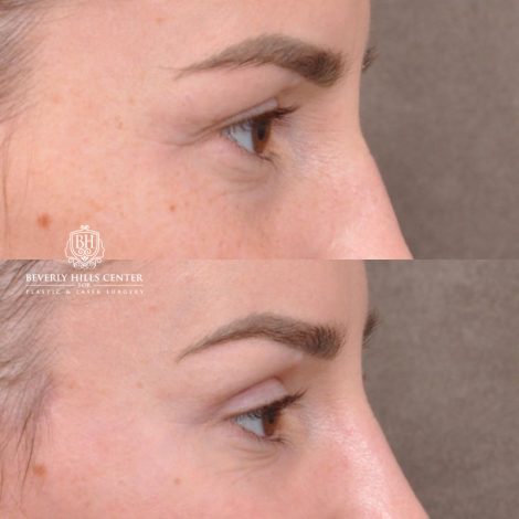 Beverly Hills Center Female Patient Before and After Hybrid Endo Brow Lift