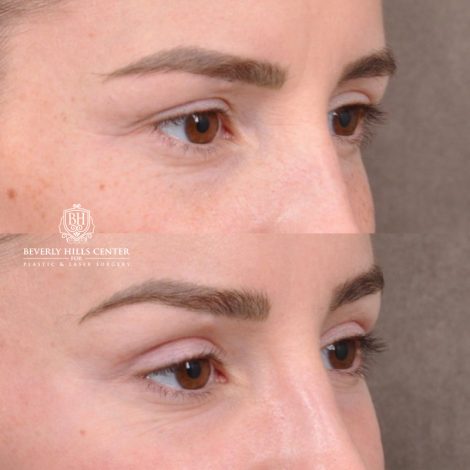 Beverly Hills Center Female Patient Before and After Hybrid Endo Brow Lift
