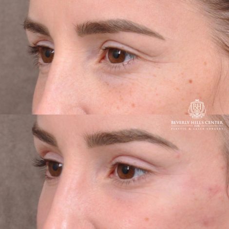 Beverly Hills Center Female Patient Before and After Hybrid Endo Brow Lift