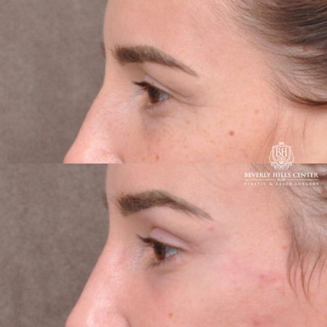 Beverly Hills Center Female Patient Before and After Hybrid Endo Brow Lift