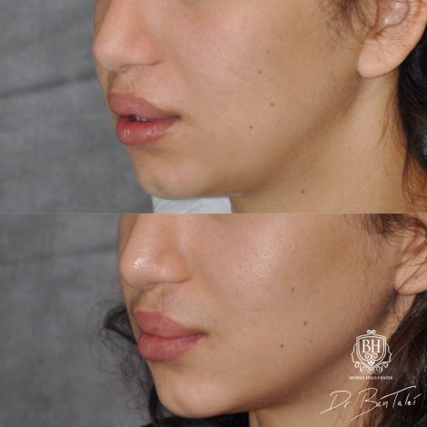 Beverly Hills Center Female Patient Before and After Cleft