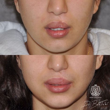 Beverly Hills Center Female Patient Before and After Cleft
