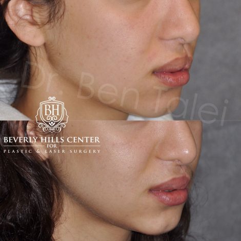 Beverly Hills Center Female Patient Before and After Cleft