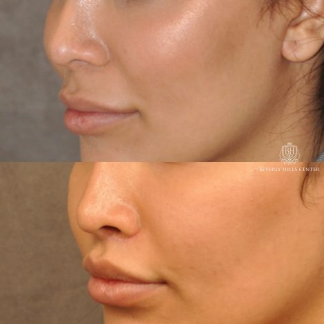 Beverly Hills Center Female Patient Before and After Modified Upper Lip Lift